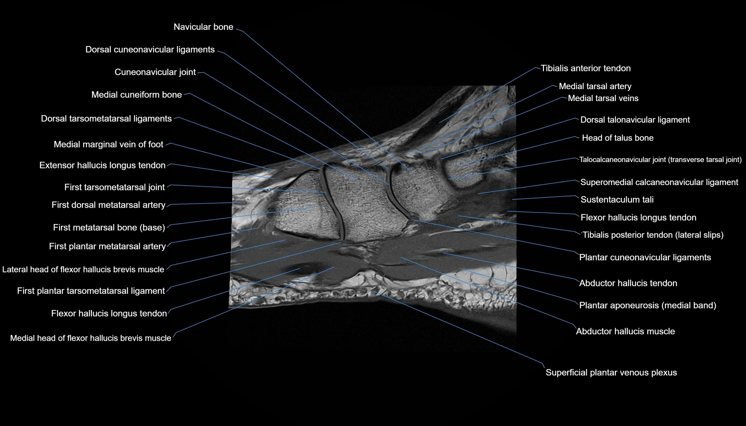 MRI mid foot sagittal cross sectional anatomy 3T  radiology  image-img-00001-00032.webp